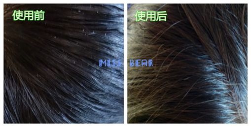 头皮屑多<em>又痒怎么办</em>?海飞丝秋冬去屑神器多重