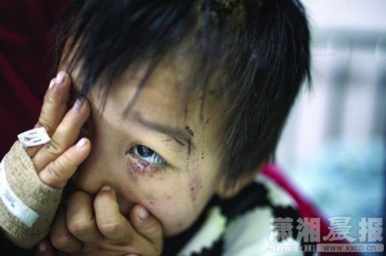 父亲一巴掌扇<em>掉</em>儿子视网膜 左眼视力降至0.1