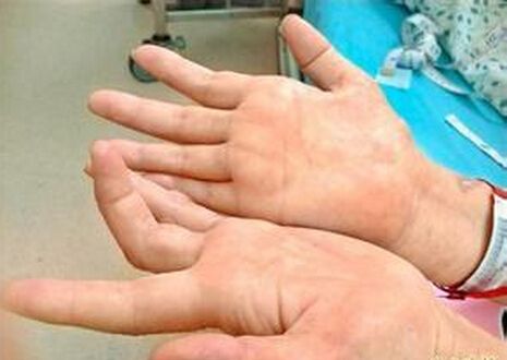 日本发现基因治疗小脑萎缩新进展 小脑萎缩症