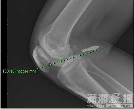 长沙男子小区内被利箭射中 膝盖洞穿12厘米(图