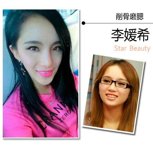 90后女星整容忙 张予曦成最佳微整范本