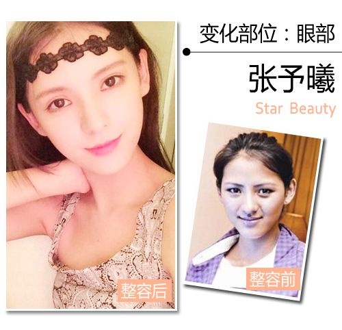 90后女星整容忙 张予曦成最佳微整范本