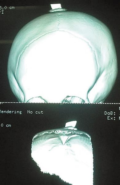 儿童医院盘点受伤孩子X光片 调皮?其实是家长
