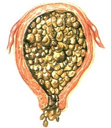 什么是葡萄胎 葡萄胎形成的原因是什么?