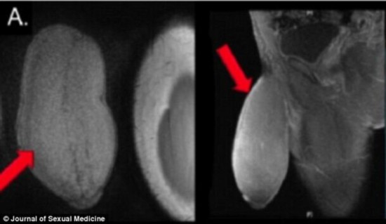 美国17岁少年接受阴茎缩小手术 系世界首例