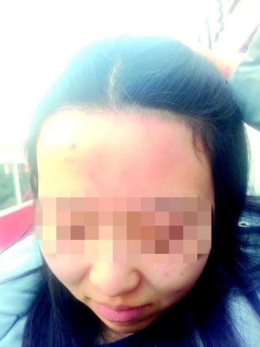 女子花两万元脱毛欲做美人尖 发际线被整成直