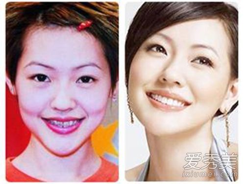 唐嫣高圆圆全智贤曾是龅牙妹 女星靠整牙变天仙