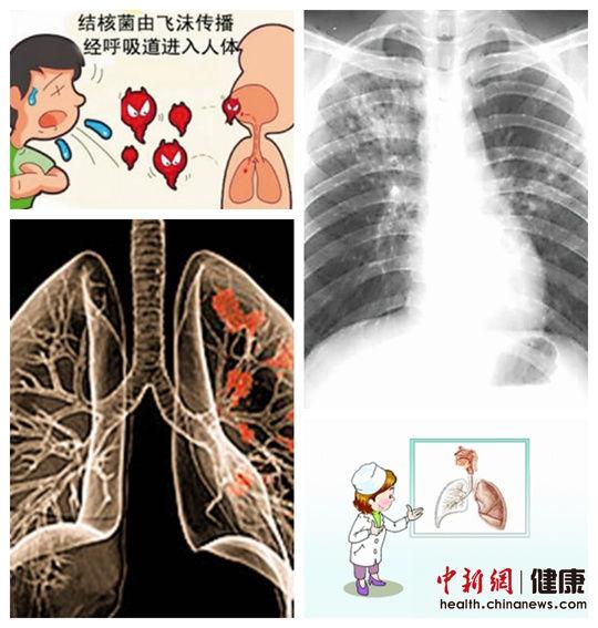 中国肺结核患者数量居世界第二位 尚无预防疫苗