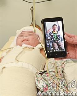 9岁男孩被高压感应电灼伤 外生殖器大部分坏死