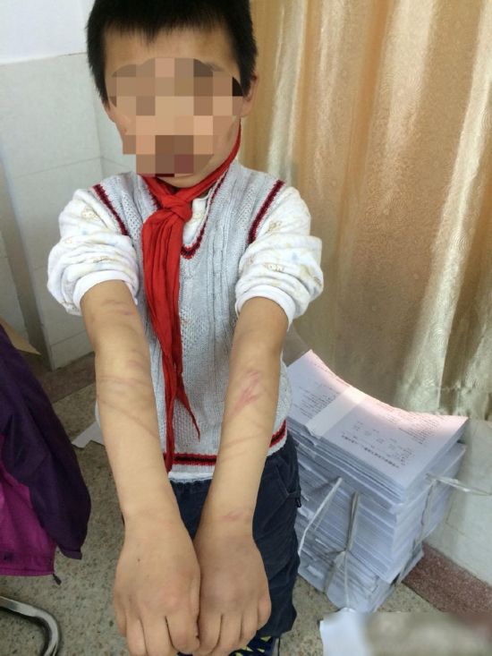南京9岁男童遭养父母虐待 背部似<em>抽打</em>(图)--山