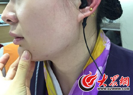 被打列车长脸被打得红肿.