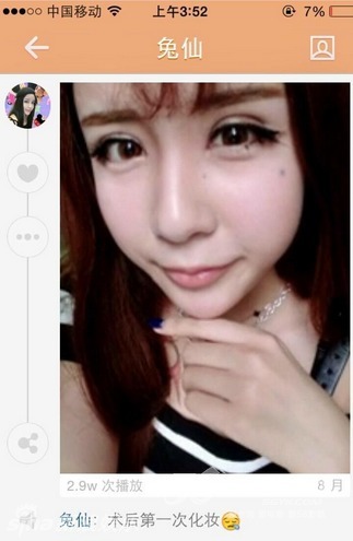 <em>15</em>岁<em>女孩</em>整成蛇精脸 自曝整容过程--重庆视窗