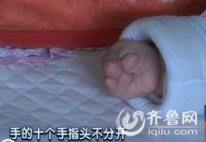 的双手十个指头分不开,像是\"猪蹄手\".-山东 女婴手脚似猪蹄需