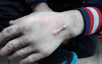 被发现男子手上的伤疤.