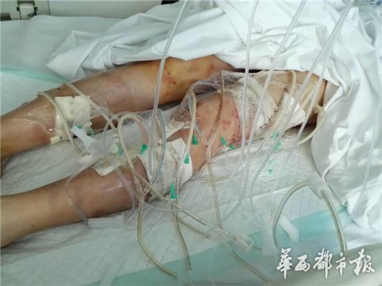 母亲保护儿子被恶犬咬伤 狗主人:狗已打死,将负