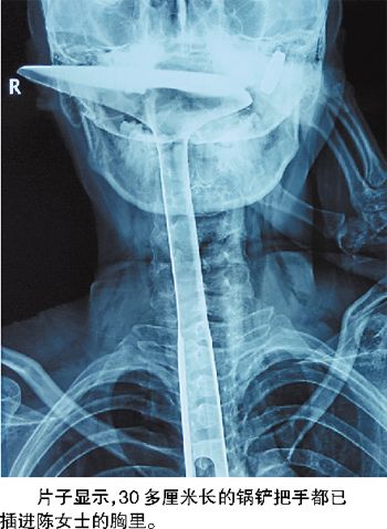 女子因喉咙难受 将30公分炒菜锅铲插进食道