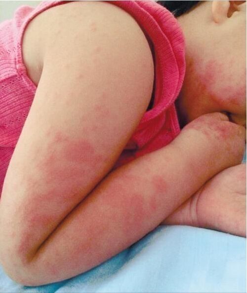 喂得精细顿顿吃肉 三岁女娃湿毒重满身红肿(图