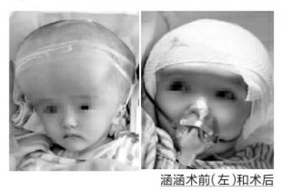 湖南大头娃娃缩脑成功 颅内液体可装一脸盆