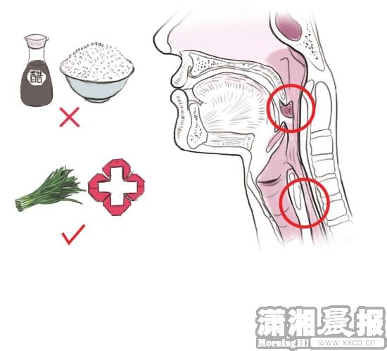 岳阳男子鱼刺卡食道没在意 13天后大出血身亡