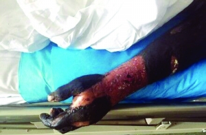 山东女子被毒蛇咬伤 在江苏找到救命血清