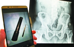 男子肛门被塞似手电筒异物 两小时手术才取出