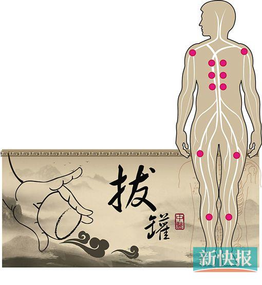 祛湿可diy拔罐,体质,诀窍须弄清