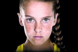 年轻人也会长老年斑 原因或是新陈代谢导致