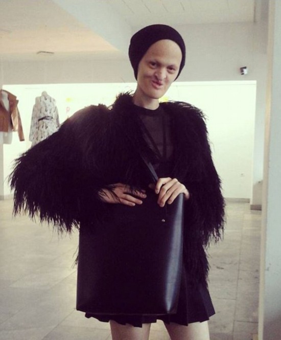 美国女模特身患罕见遗传病 光头没牙展示别样