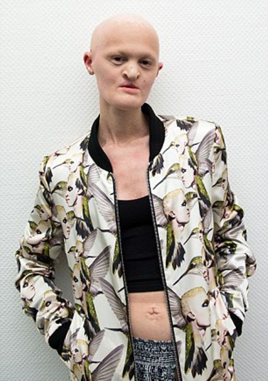 美国女模特身患罕见遗传病 光头没牙展示别样