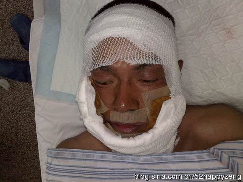 意外惨 毁容 的明星: 俞灏明 烧伤胡歌车祸  毁容 前