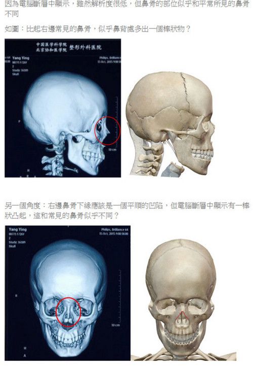 台整形医师质疑baby面部鉴定结果:鼻骨有棒状物
