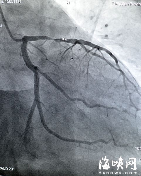 近距直击心脏支架手术 堪称命悬一线的交战