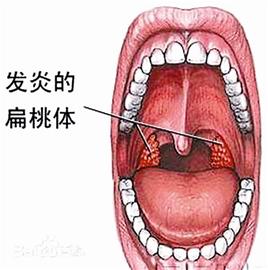 市民听信偏方抠掉半边扁桃体 医生:喉咙不适应