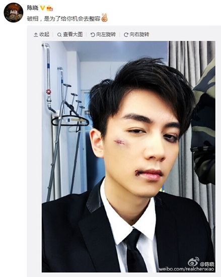 陈晓微博截图昨日,陈晓在微博晒出一张脸部受伤的照片,调皮留言称,"