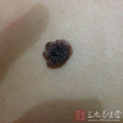 这里有黑点竟是恶性肿瘤