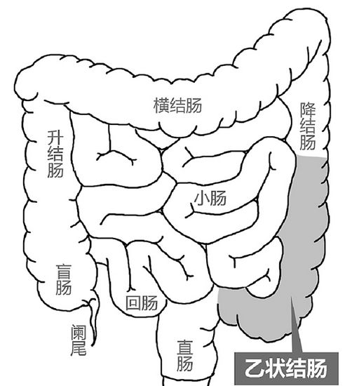 小伙胡吃海喝致肠子扭转360度胀气 肿得像篮球