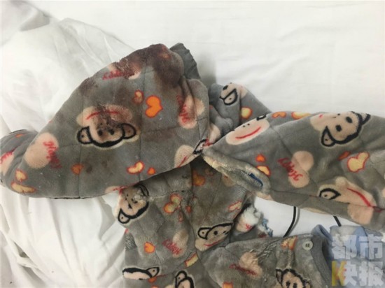 一岁半男婴右臂夹进三轮车拇指断裂胳膊七八处