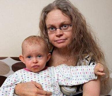  少年患病似吸血鬼  千奇百怪的疾病除了吸血鬼