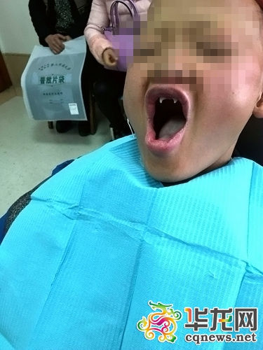 男孩患怪病酷似吸血鬼 长獠牙畏光(图)