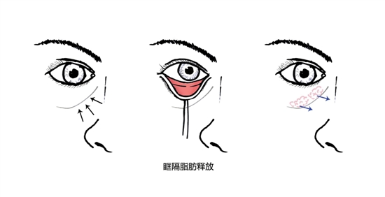 眼部脂肪金贵 去眼袋后别浪费