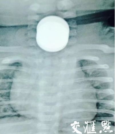 南京一两月大婴儿被两岁贪玩哥哥喂下3枚硬币