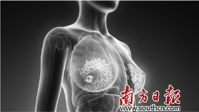 乳房摸到肿块不一定是乳腺癌