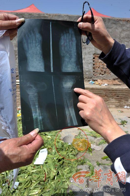 未央区一菜市场排污井没井盖 老人摔伤五处骨