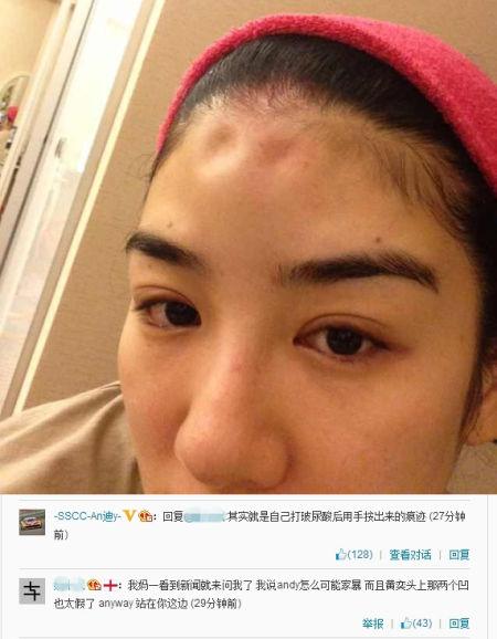 黄奕被曝整容打玻尿酸 现场图片曝光(组图)