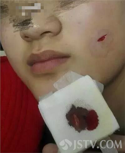 南通一中学16岁少女遭男同学用美工刀划破脸