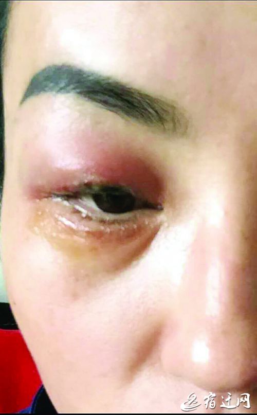 宿迁爱美女子花835元洗眼线 遭激光烧伤眼睛