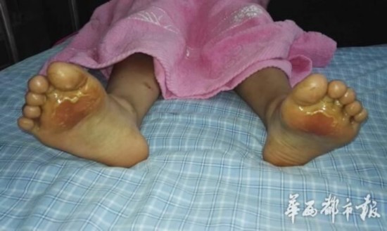 小学生37度高温被罚光脚跑 脚掌被烫伤红肿溃