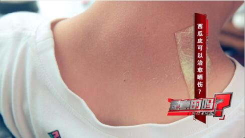西瓜皮可以治愈晒伤?专家称只能缓解疼痛