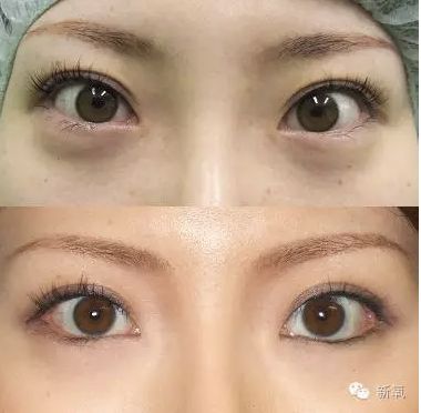 也就是将下眼睑的位置向下调整,让眼睛变得更大,   再看志玲姐姐疑似