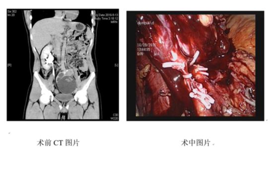 19岁大学生的左肾不见了 先天性异位 “藏”入盆腔--湖南频道--人民网